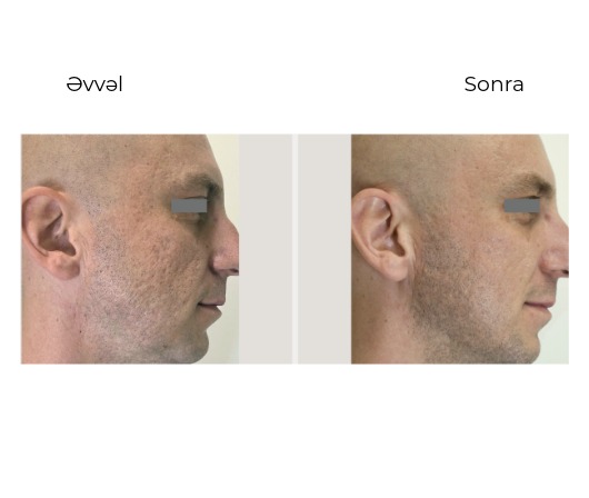 Candela Nordlys Mini